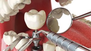 Diş implantı yaptırmadan önce bilmeniz gerekenler