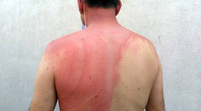 Tartıştığı komşusunun üzerine kaynar su döken kişi serbest bırakıldı