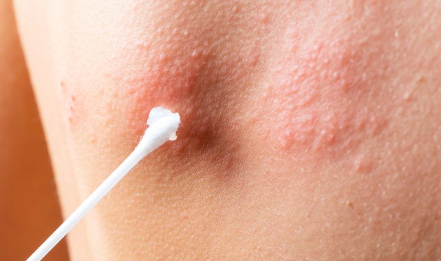 Stres ve bağışıklık düşüklüğü zonayı tetikliyor